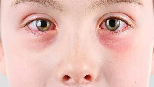 Аллергическая Сыпь У Ребенка Фото крупный план глаз человека