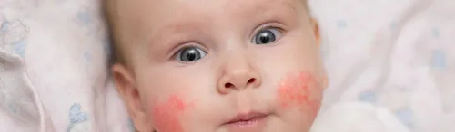 Аллергическая Сыпь У Ребенка Фото HD