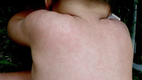 Аллергическая Сыпь У Ребенка Фото крупный план груди человека