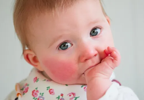 Аллергическая Сыпь У Ребенка Фото ребенок с пальцем во рту