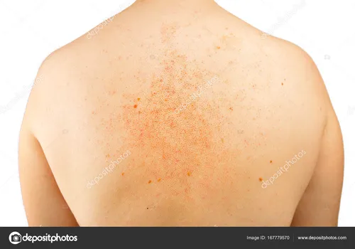 Аллергия На Солнце Фото рука человека крупным планом