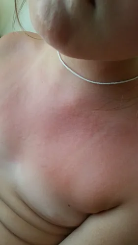 Аллергия На Солнце Фото крупный план уха человека