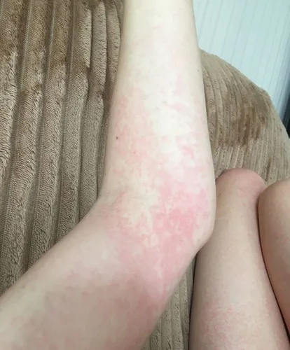 Аллергия На Солнце Фото крупный план ноги