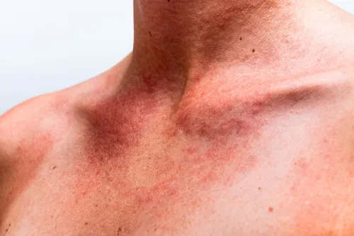 Аллергия На Солнце Фото крупный план кожи человека