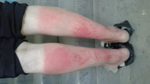 Аллергия На Солнце Фото крупный план ног человека