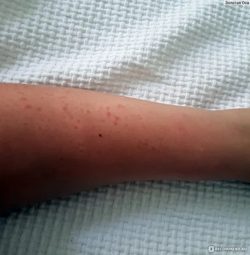 Аллергия На Солнце Фото рука человека с сыпью на ней