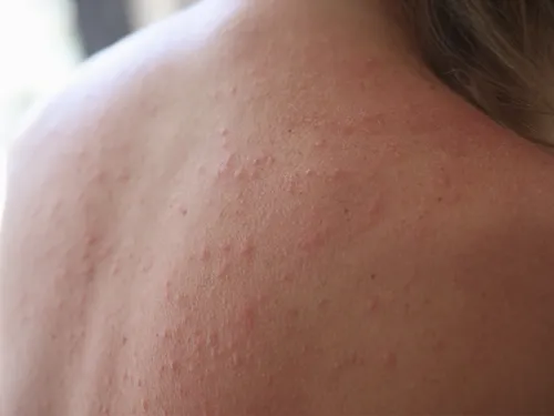Аллергия На Солнце Фото крупный план спины человека