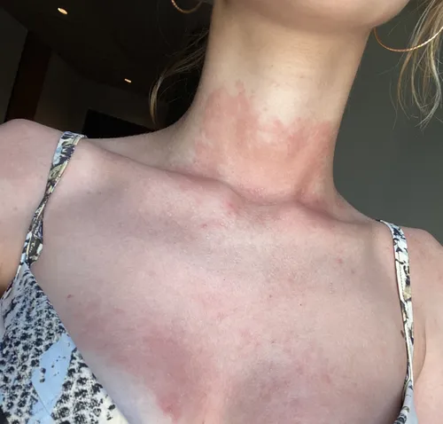 Аллергия На Солнце Фото грудь женщины крупным планом
