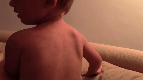 Аллергия На Солнце Фото спина ребенка с грудью человека