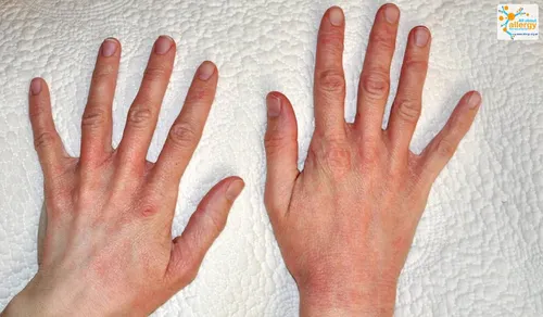 Аллергия На Солнце Фото пара рук на белой поверхности