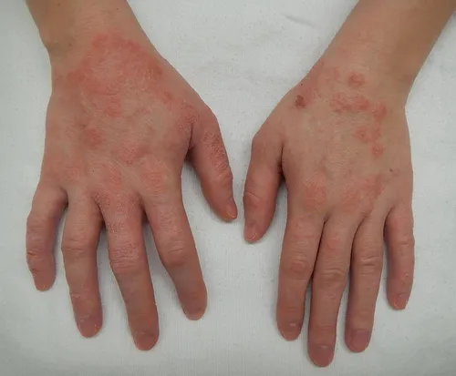 Аллергия На Солнце Фото руки крупным планом