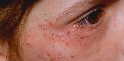 Аллергия На Солнце Фото крупный план глаза человека