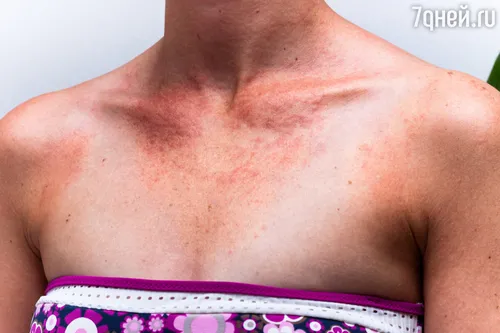 Аллергия На Солнце Фото крупный план груди человека
