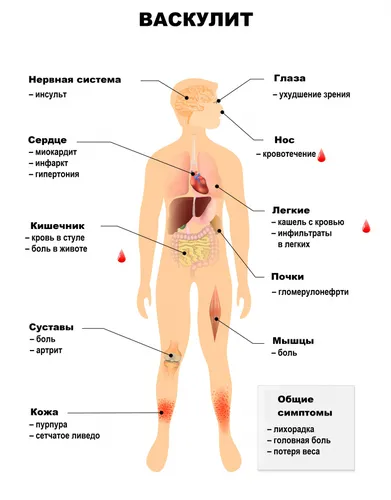 Васкулит Сыпи Фото диаграмма