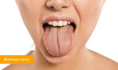 Воспаление Языка Фото крупный план женского рта