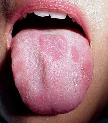 Воспаление Языка Фото у человека открыт рот