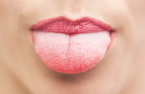 Воспаление Языка Фото крупный план губ человека