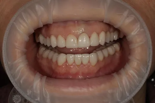 Воспаление Языка Фото рот человека с зубами
