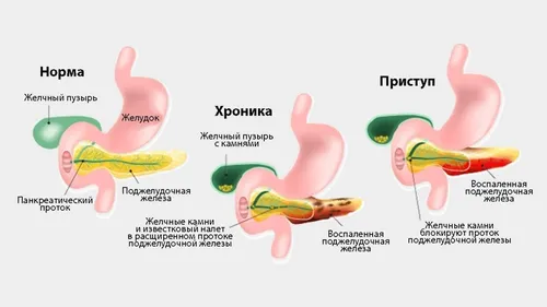 Где Болит При Панкреатите Фото эстетика