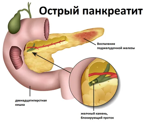 Где Болит При Панкреатите Фото HD