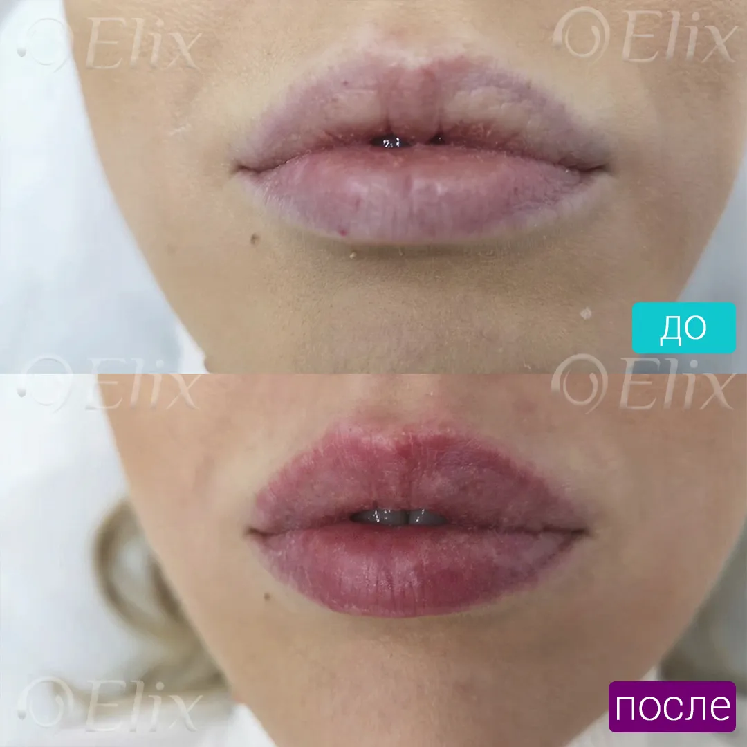 Увлажнение губ до и после. Увлажнение губ гиалуроновой кислотой. Контурная пластика губ до и после. Пигментация губ до после. Увлажнение губ у косметолога.