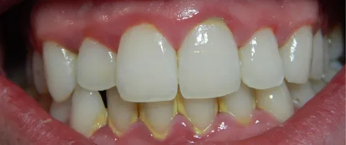 Зубной Камень Фото изображение