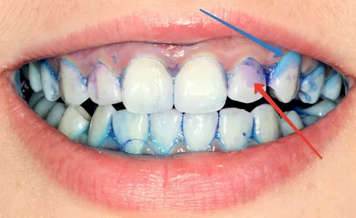 Зубной Камень Фото рот человека с зубной щеткой