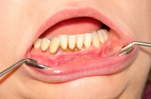 Зубной Камень Фото рот человека с зубами и ложкой