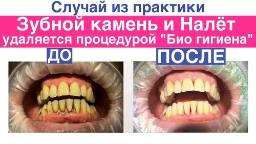 Зубной Камень Фото коллаж лица человека