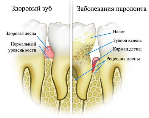 Зубной Камень Фото диаграмма