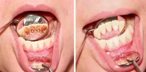 Зубной Камень Фото крупный план рта человека с кольцом на нем