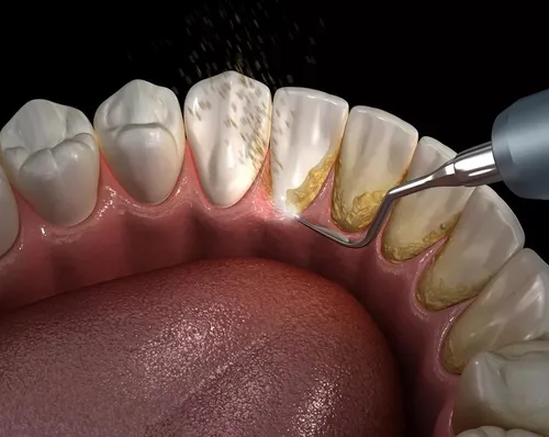Зубной Камень Фото крупный план рта человека