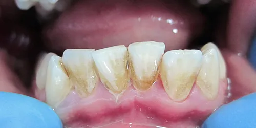 Зубной Камень Фото рот человека с зубами