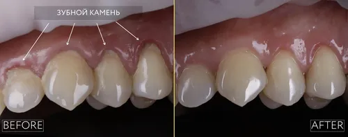 Зубной Камень Фото человеческий рот крупным планом