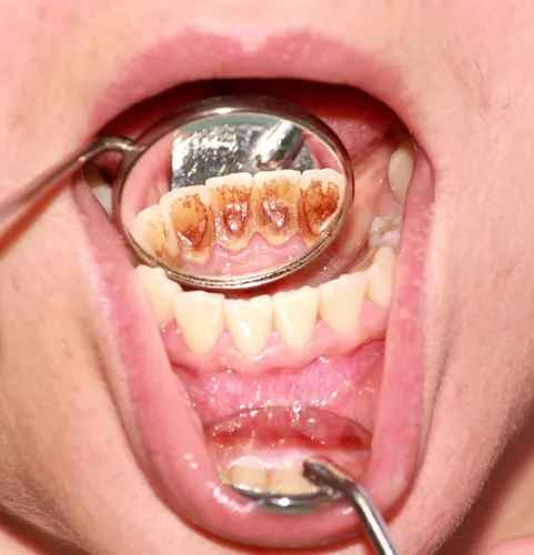 Зубной Камень Фото рот человека с ложкой в нем
